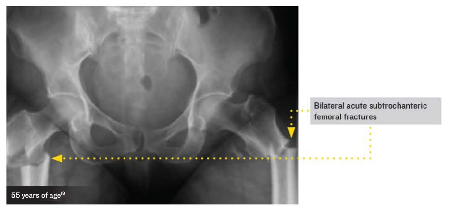 Skeletal Symptoms of Hypophosphatasia: Bone Pain, Frequent Fractures
