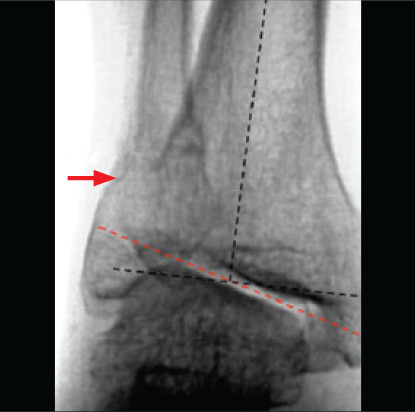 The devastating consequences of hypophosphatasia in adults